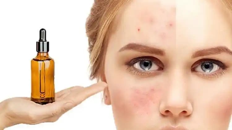 Sivilceye Karşı Doğal Yağlar ve Kullanım İpuçları Cilt Sağlığını Destekler