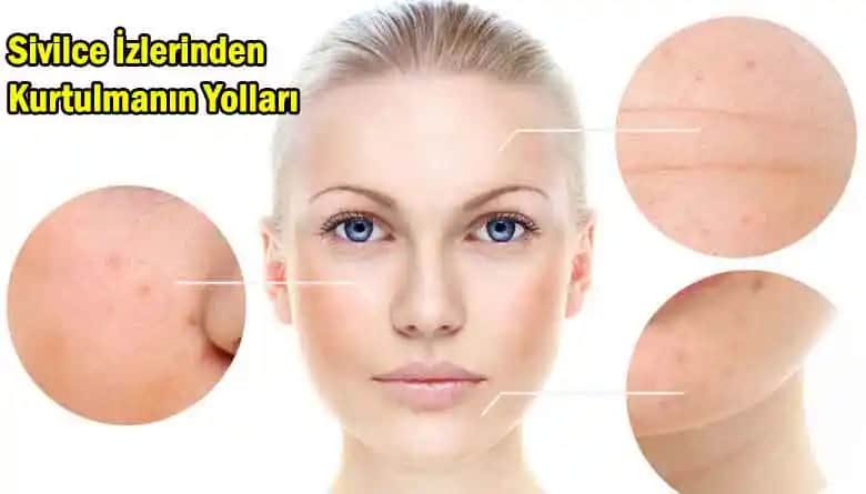 Sivilceye Karşı Etkili Çözümler ve Sağlıklı Cilt İçin Rehber