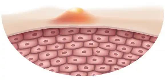 Sivilceye Yatkın Ciltler İçin Kozmetik Seçimleri ve Doğru Bakım Yöntemleri