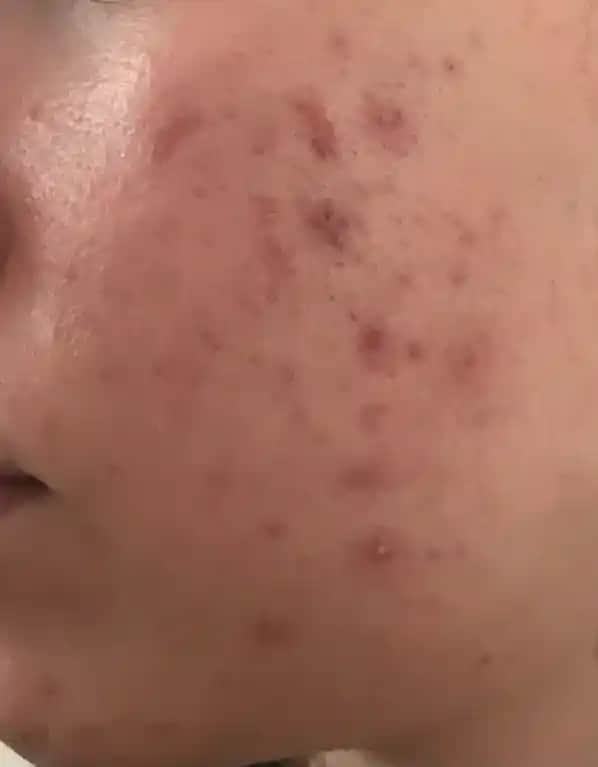 Sivilceyle Mücadele Yöntemleri ve Uzman Tavsiyeleri