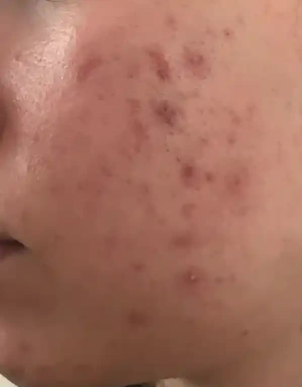 Sivilceyle Mücadele Yöntemleri ve Uzman Tavsiyeleri