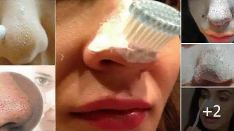 Siyah Nokta Temizliği ve Bakımı: Cilt Sağlığınız İçin Güncel ve Etkili Rehber