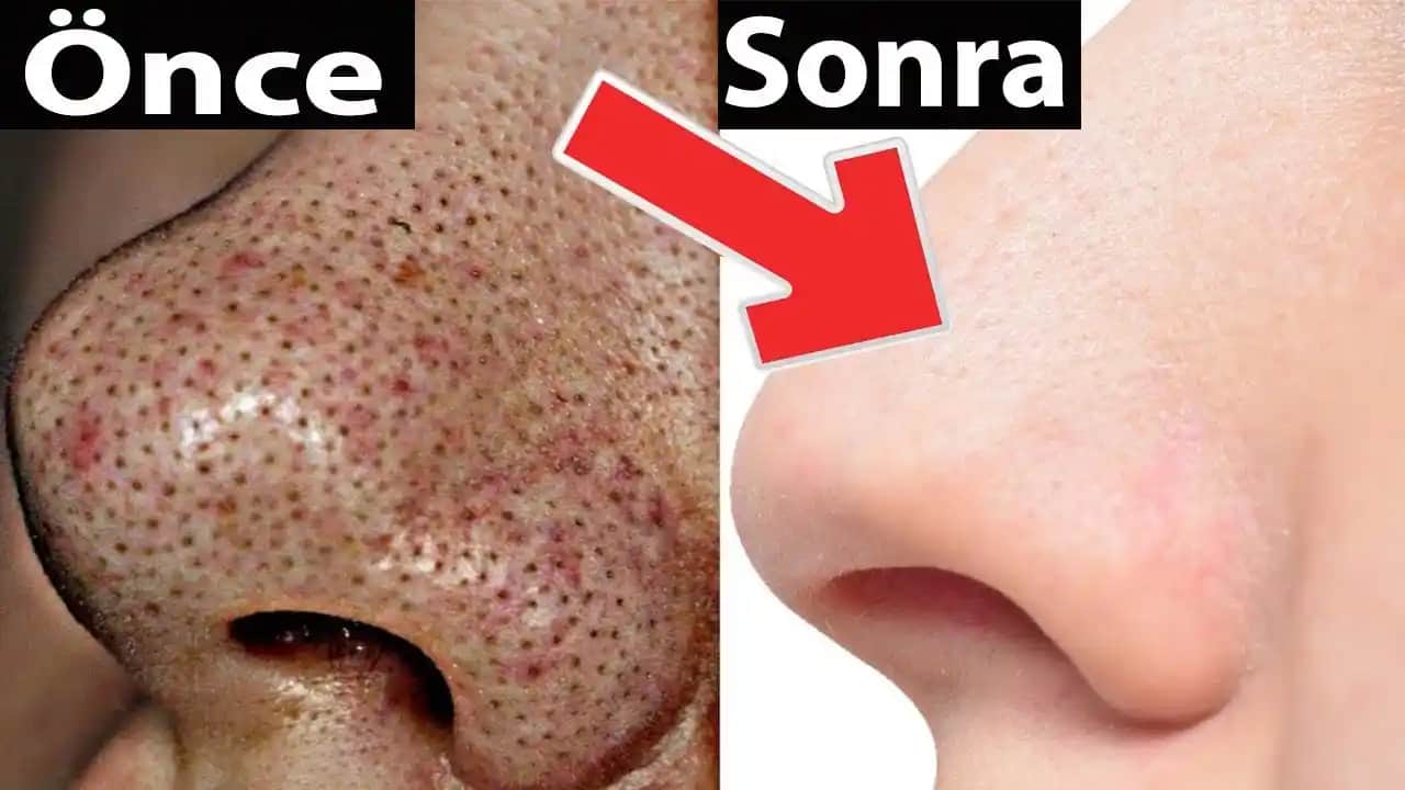Siyah Nokta ve Sivilce Problemleri İçin Etkili Cilt Bakım Yöntemleri ve Uzman Tavsiyeleri