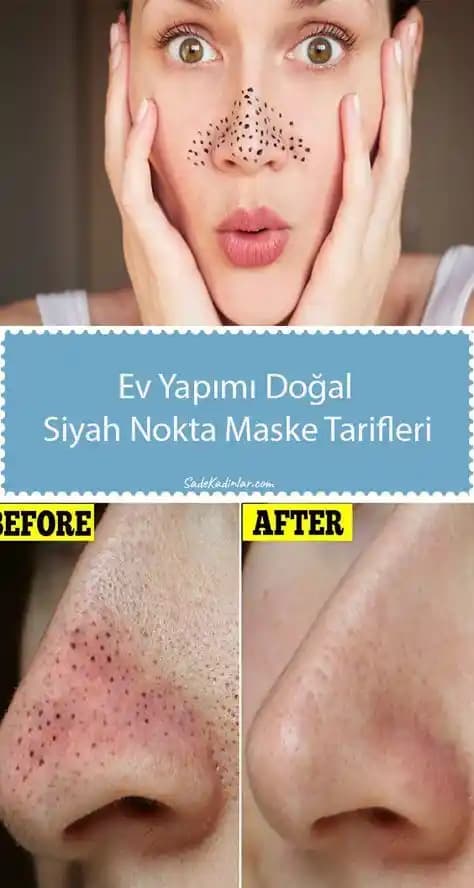 Siyah Noktalardan Kurtulma Yöntemleri ve Cilt Bakımında Uygulanabilir Tavsiyeler
