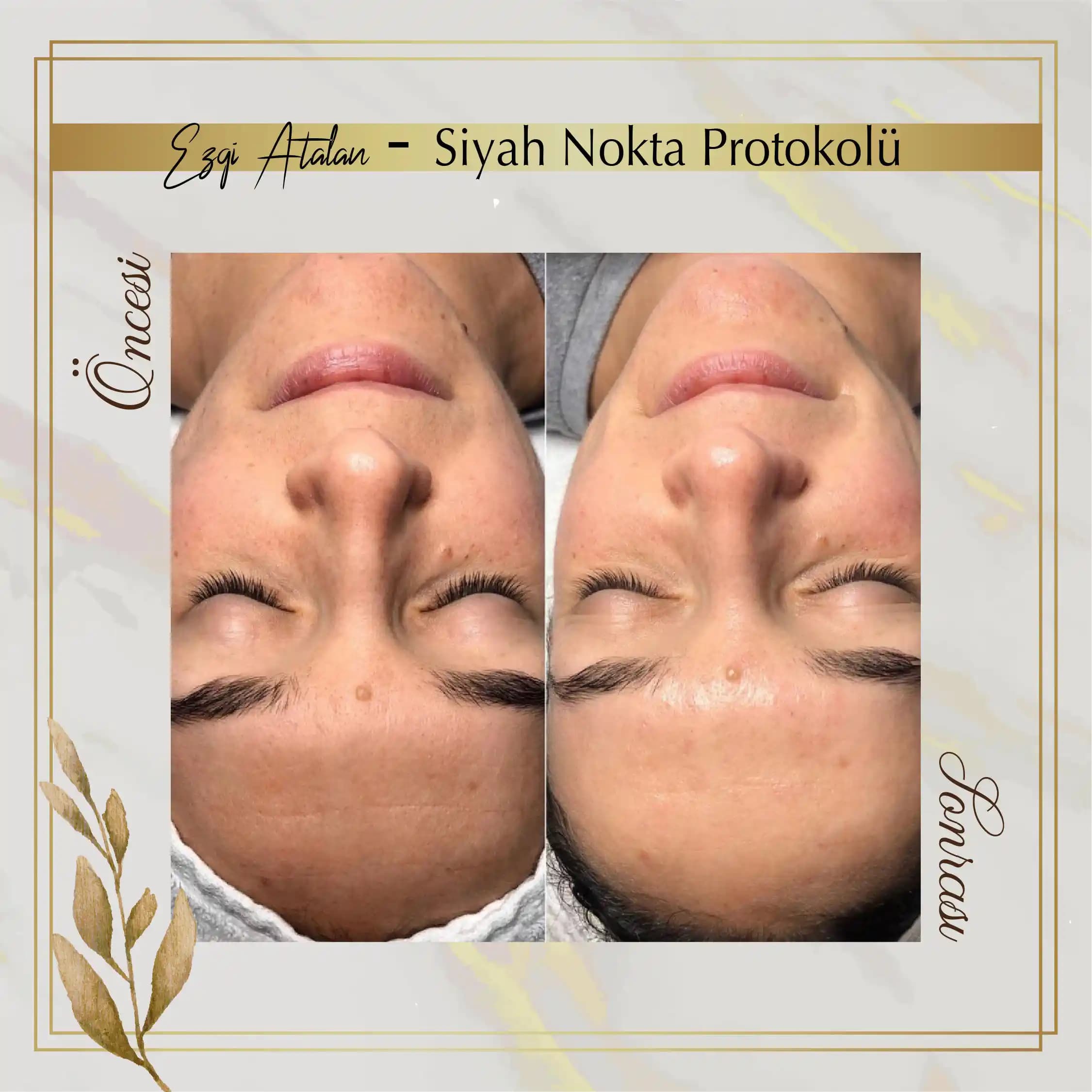 Siyah Noktalarla Mücadele İçin Etkili ve Uzun Süreli Cilt Bakım Yöntemleri