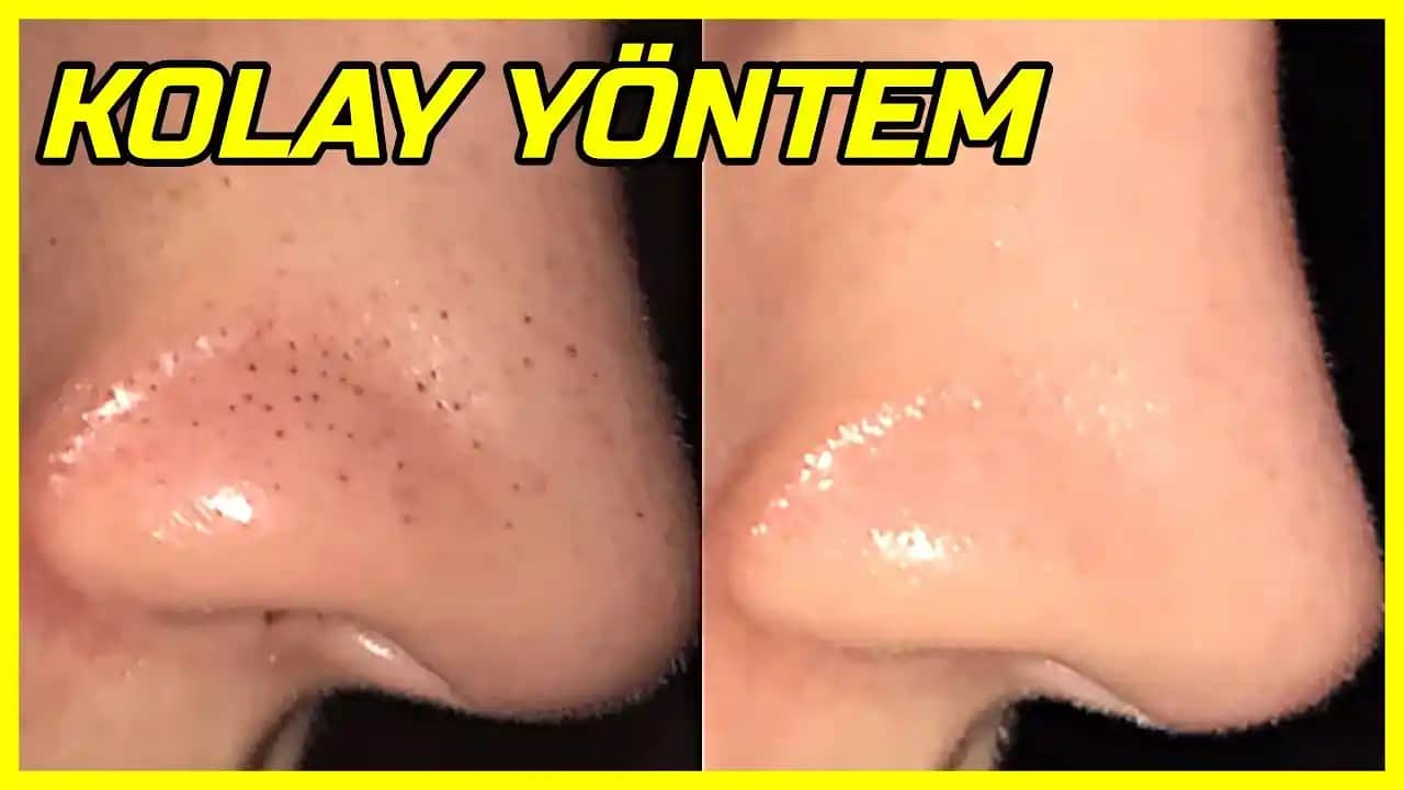 Siyah Noktalarla Mücadelede Doğal ve Etkili Evde Temizlik Yöntemleri