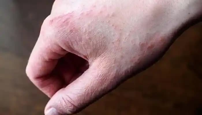 Stres Bağlı Egzama Çeşitleri ve Kozmetik Yaklaşımlar: Cilt Sağlığını Korumada Bilinçli Adımlar