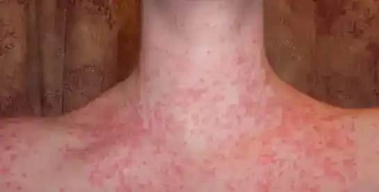 Stres Kaynaklı Cilt Kızarıklıkları ve Kırmızı Lekeler İçin Etkili Çözüm Yöntemleri