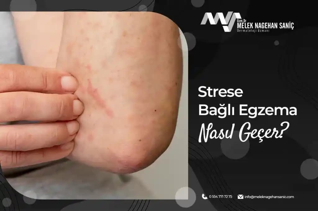 Stres ve Boyun Egzaması: Cilt Sağlığını Olumsuz Etkileyen Faktörler ve Yönetim Yöntemleri