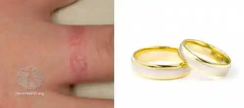 Takı Alerjisi Nedir, Belirtileri ve Sağlıklı Kullanım Yöntemleri