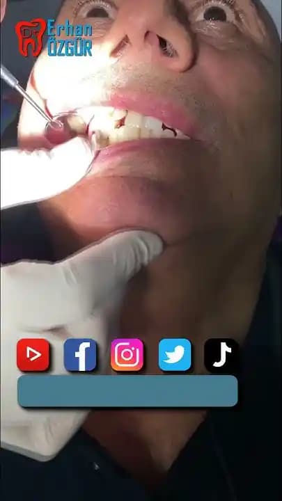 Takma Diş Yapıştırıcıları: Güvenli Kullanım ve Etkinlik İçin Bilmeniz Gerekenler