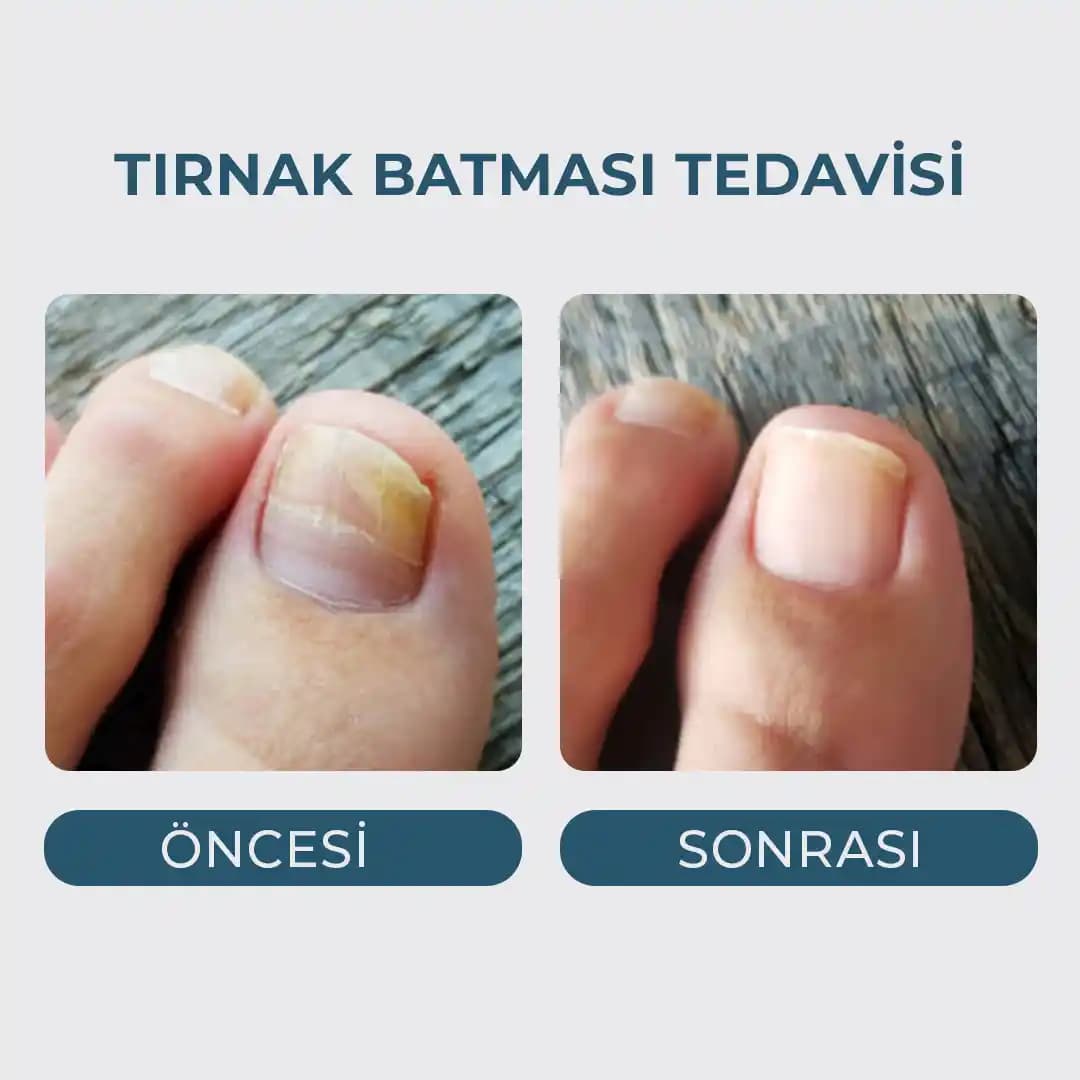 Tırnak Düşmesi ve Zayıflaması İçin Etkili Tedavi Yöntemleri ve Günlük Bakım İpuçları