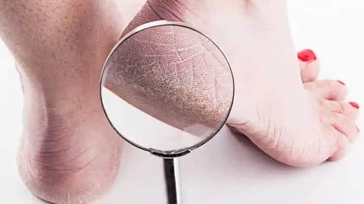 Topuk Çatlaklarının Nedenleri, Çözüm Yolları ve Etkili Bakım İpuçları