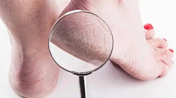 Topuk Çatlaklarının Nedenleri, Çözüm Yolları ve Etkili Bakım İpuçları