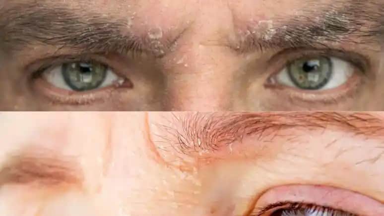 Vücut Kepeklenmesinin Nedenleri ve Etkili Çözüm Yöntemleri Hakkında Kapsamlı Bilgi