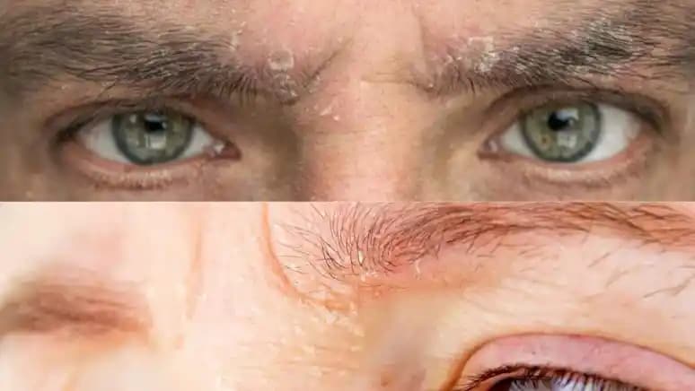 Vücut Kepeklenmesinin Nedenleri ve Etkili Çözüm Yöntemleri Hakkında Kapsamlı Bilgi