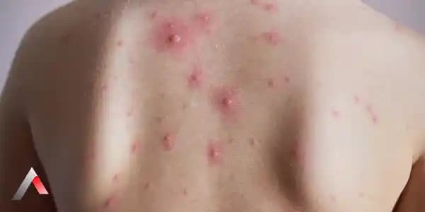 Vücutta Aniden Çıkan Kabarcıkların Nedenleri ve Korunma Yöntemleri