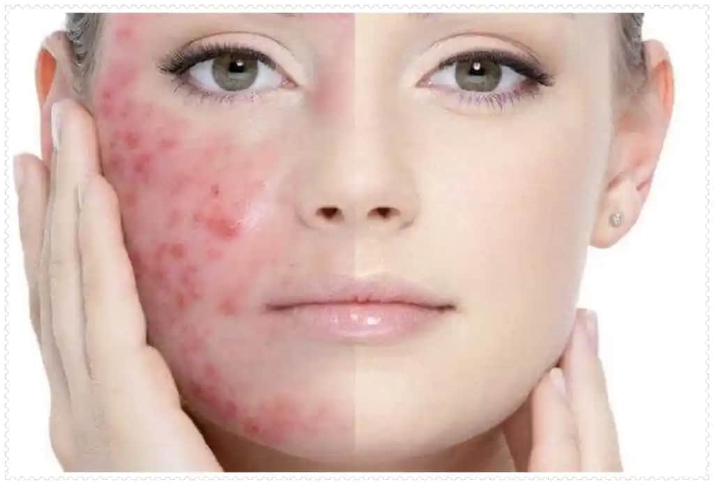 Vücutta Çıkmış İltihaplı Sivilceler: Nedenleri, Tedavi Yöntemleri ve Korunma İpuçları