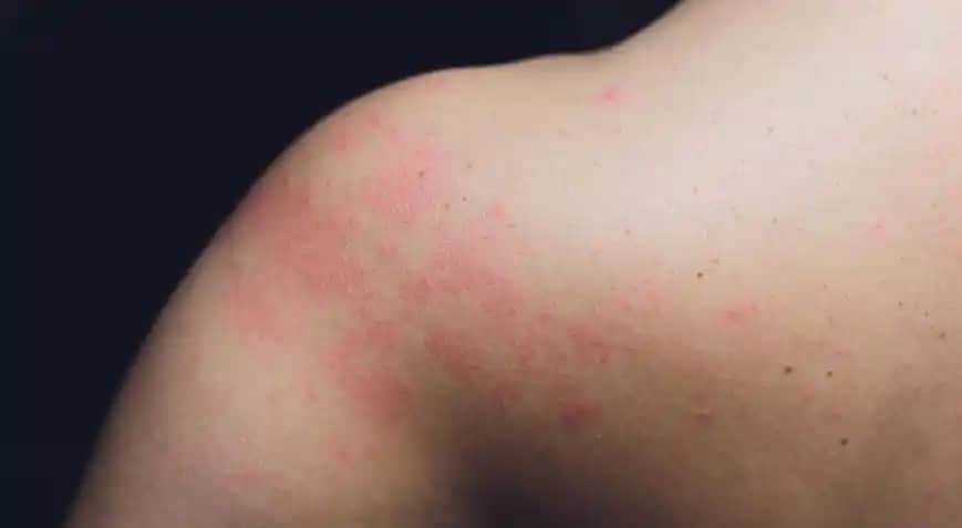 Vücutta Daire Şeklinde Kızarıklıkların Nedenleri, Tedavi Yöntemleri ve Önlemler