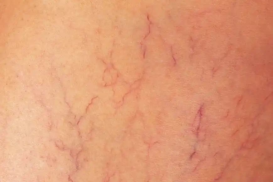 Vücutta Damar Çatlaması Nedenleri Belirtileri ve Etkili Çözüm Yolları