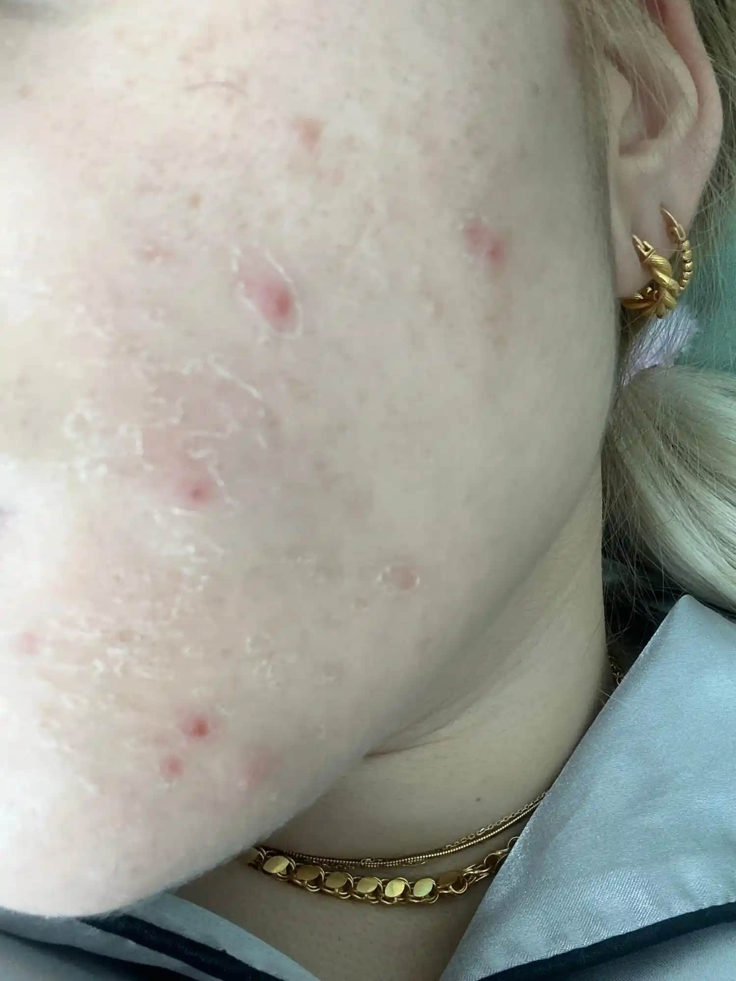 Vücutta Görülen Sivilce Benzeri Lezyonların Nedenleri ve Çözüm Yolları