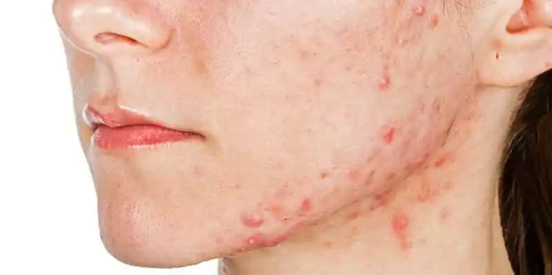 Vücutta İltihaplı Sivilce Nedenleri ve Etkili Çözüm Yolları Hakkında Kapsamlı Bilgi