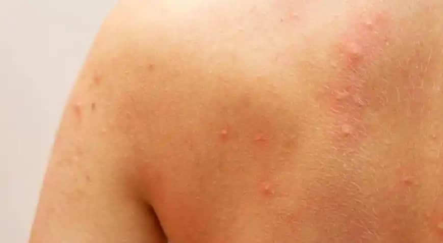 Vücutta Kaşıntılı Kırmızı Kabarcıkların Nedenleri ve Etkili Çözüm Yöntemleri