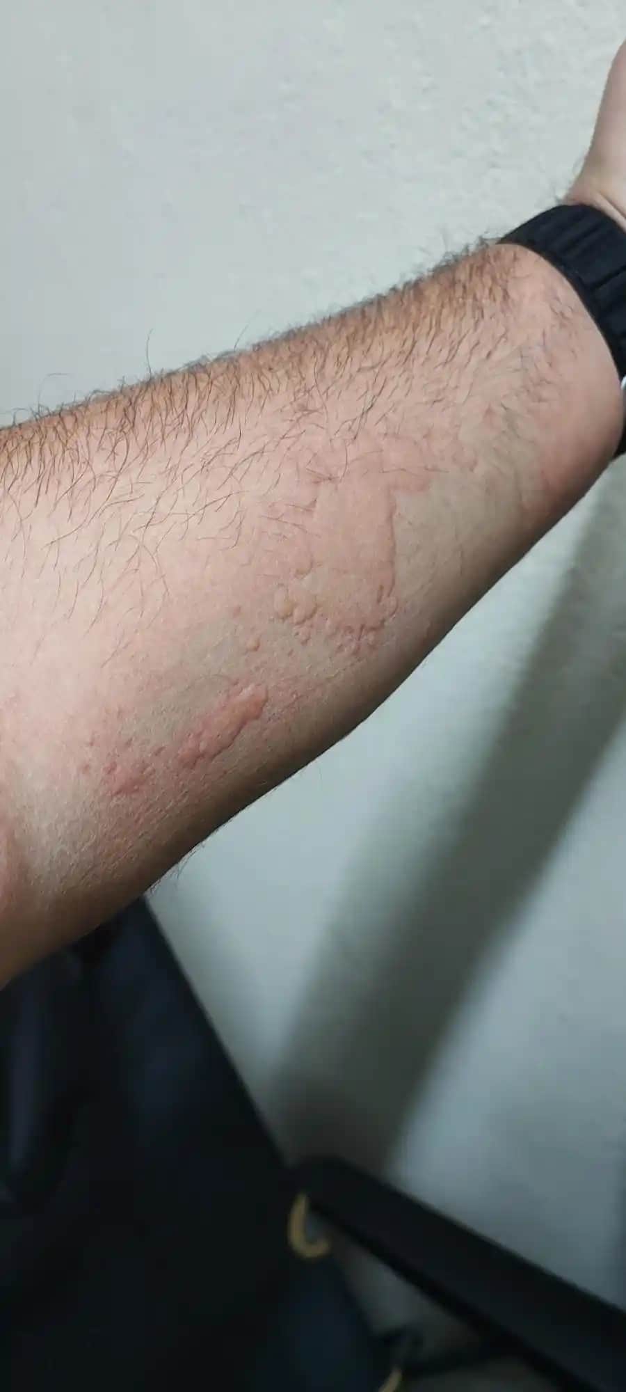 Vücutta Kaşıntılı Kızarıklar ve Kozmetik Ürünlerle İlişkisi Hakkında Detaylı Bilgi