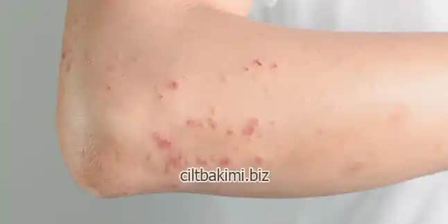 Vücutta Kırmızı Lekeler ve Kaşıntı: Kozmetik ve Sağlık Açısından Detaylı İnceleme