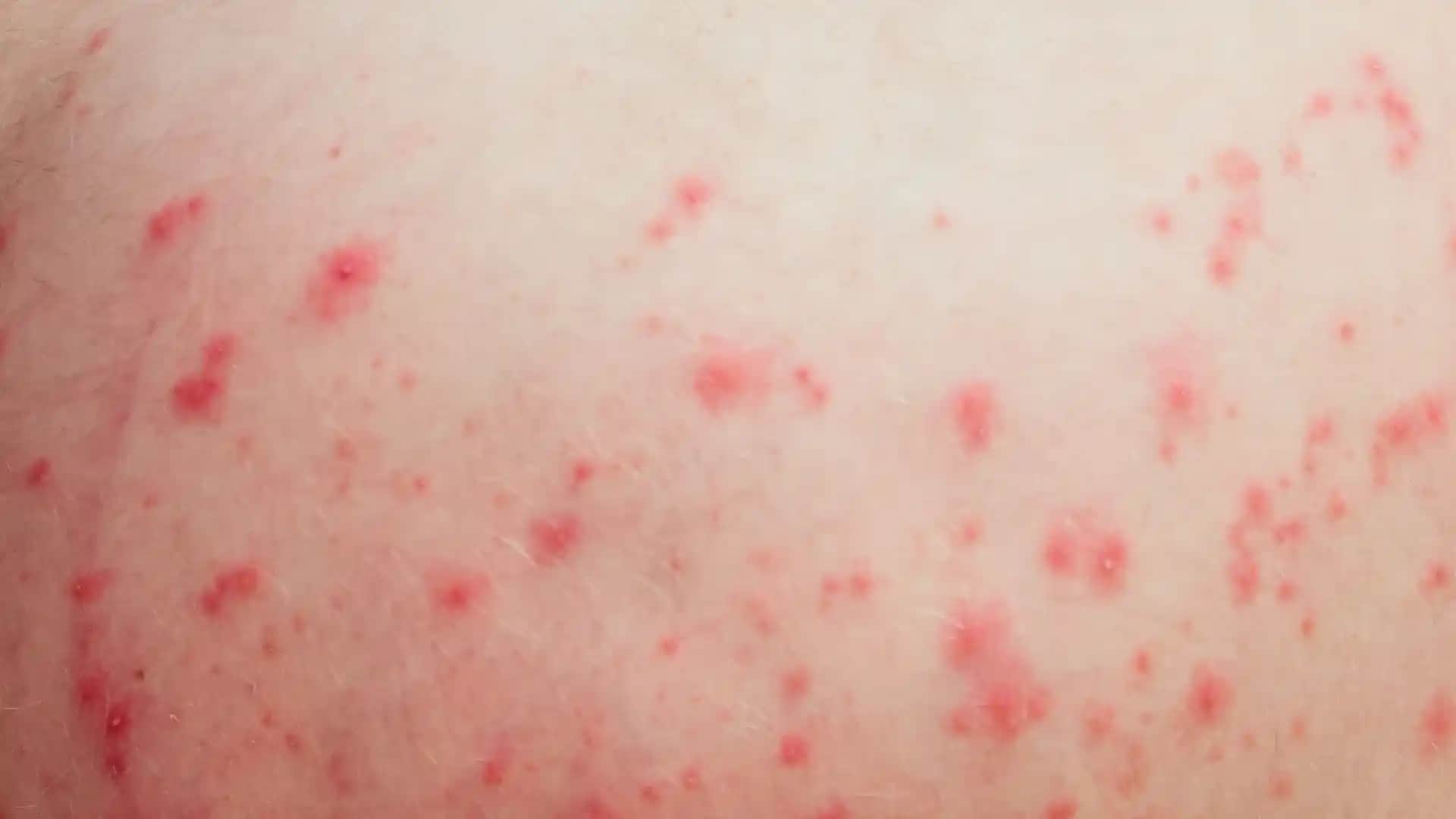 Vücutta Kırmızı Noktaların Nedenleri ve Uygun Tedavi Yöntemleri Hakkında Bilgi