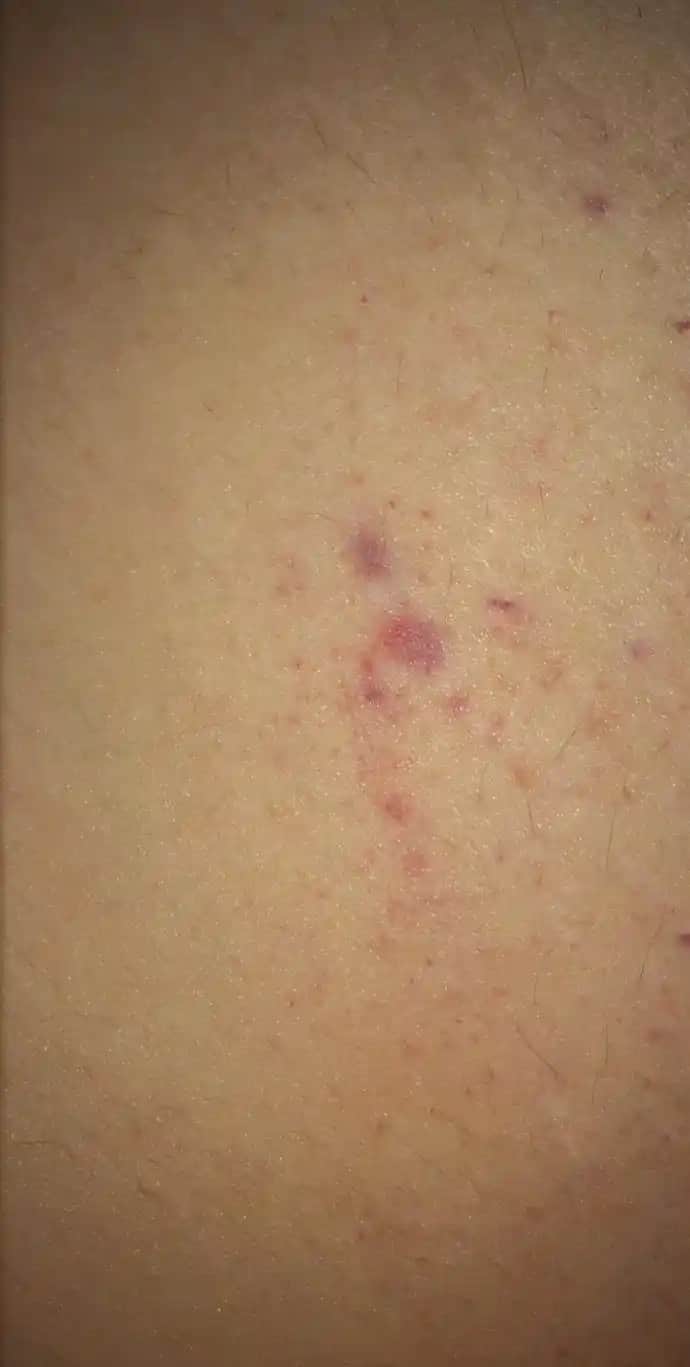 Vücutta Kızarıklık Nedenleri, Belirtileri ve Etkili Çözüm Yolları