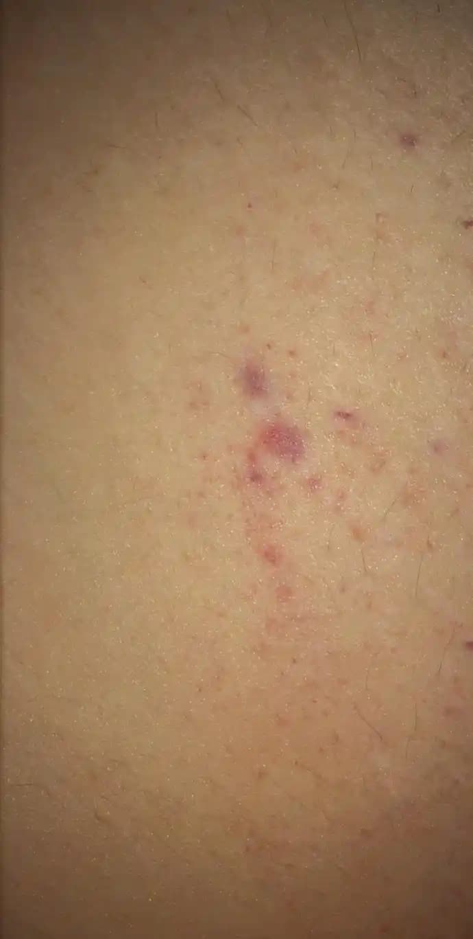 Vücutta Kızarıklık Nedenleri, Belirtileri ve Etkili Çözüm Yolları