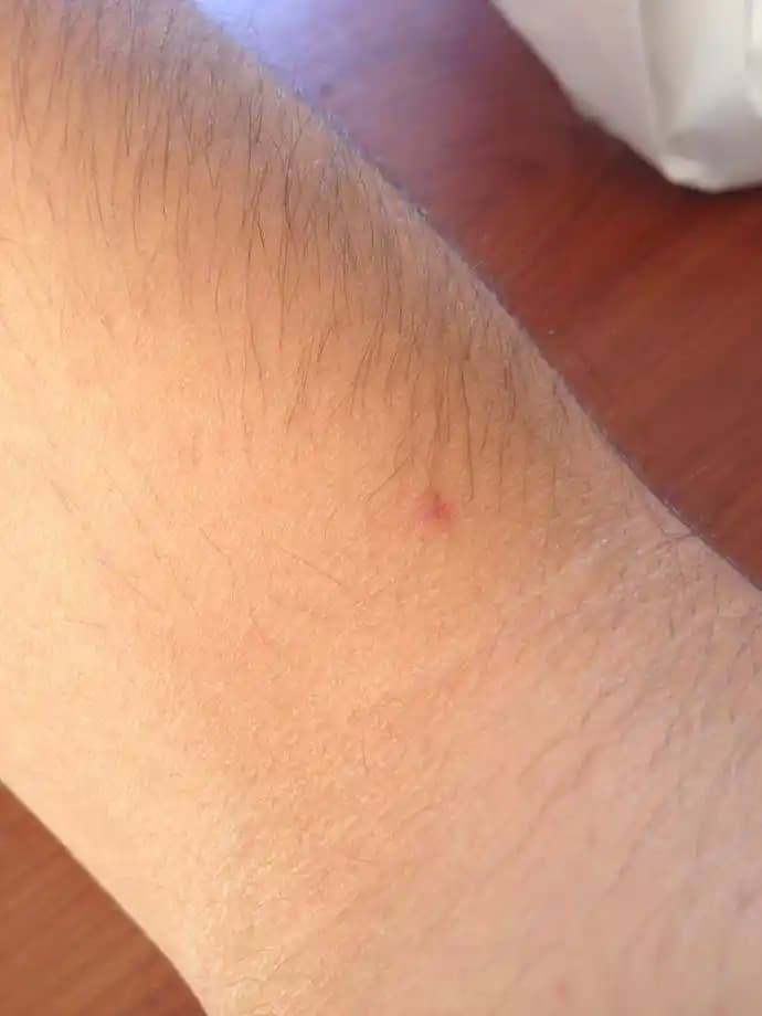 Vücutta Lekelerin Nedenleri ve Etkili Tedavi Yöntemleri