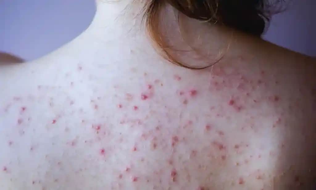 Vücutta Nokta Nokta Kabarmalar ve Kozmetik Yaklaşımlar Üzerine Detaylı Bilgi