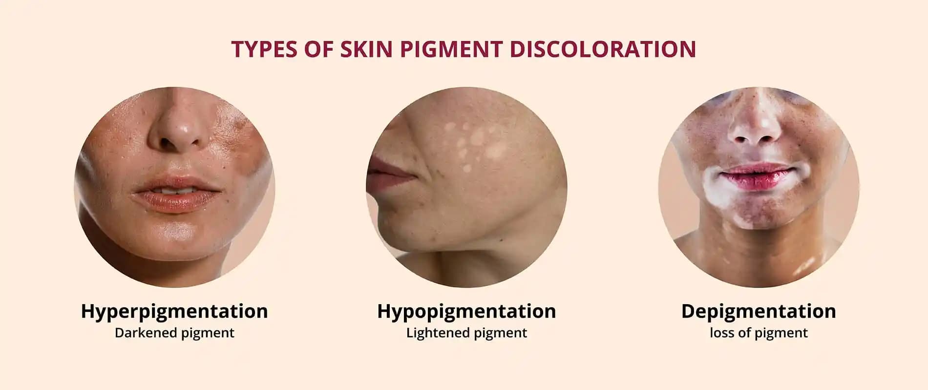 Vücutta Pigment Eksikliği ve Cilt Sağlığı İçin Etkili Kozmetik ve Tedavi Yöntemleri