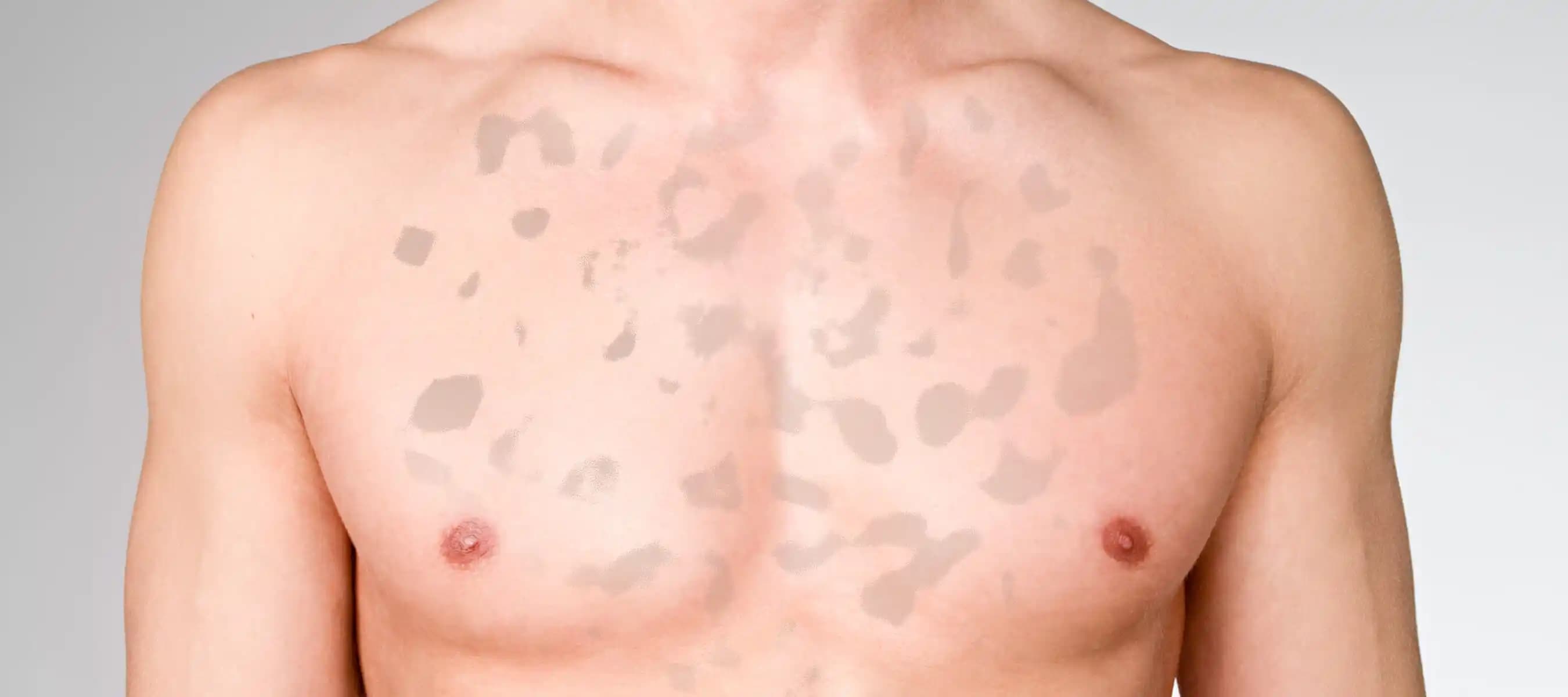 Vücutta Sarı Lekelerin Nedenleri ve Etkili Tedavi Yöntemleri