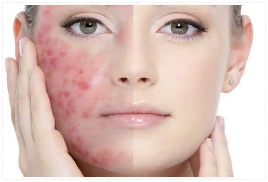 Vücutta Sivilce Çıkmasının Nedenleri ve Etkili Çözüm Yolları