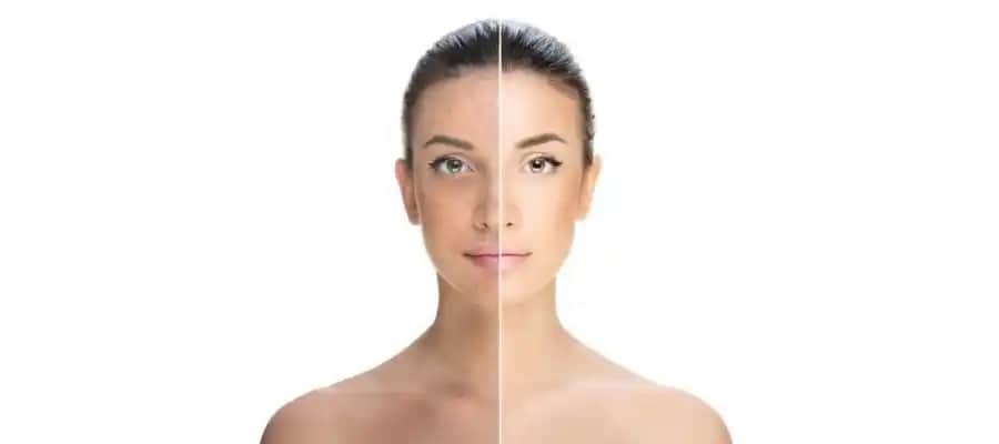 Vücutta Sivilceler Nasıl Giderilir: Etkili ve Kalıcı Çözüm Yöntemleri