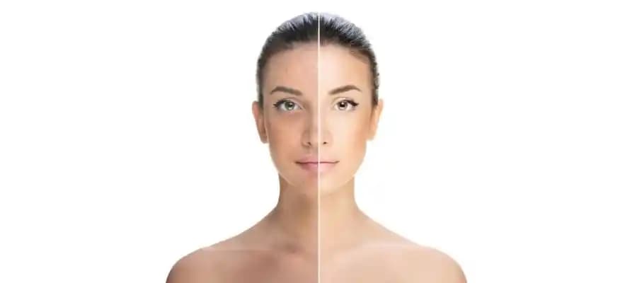 Vücutta Sivilceler Nasıl Giderilir: Etkili ve Kalıcı Çözüm Yöntemleri