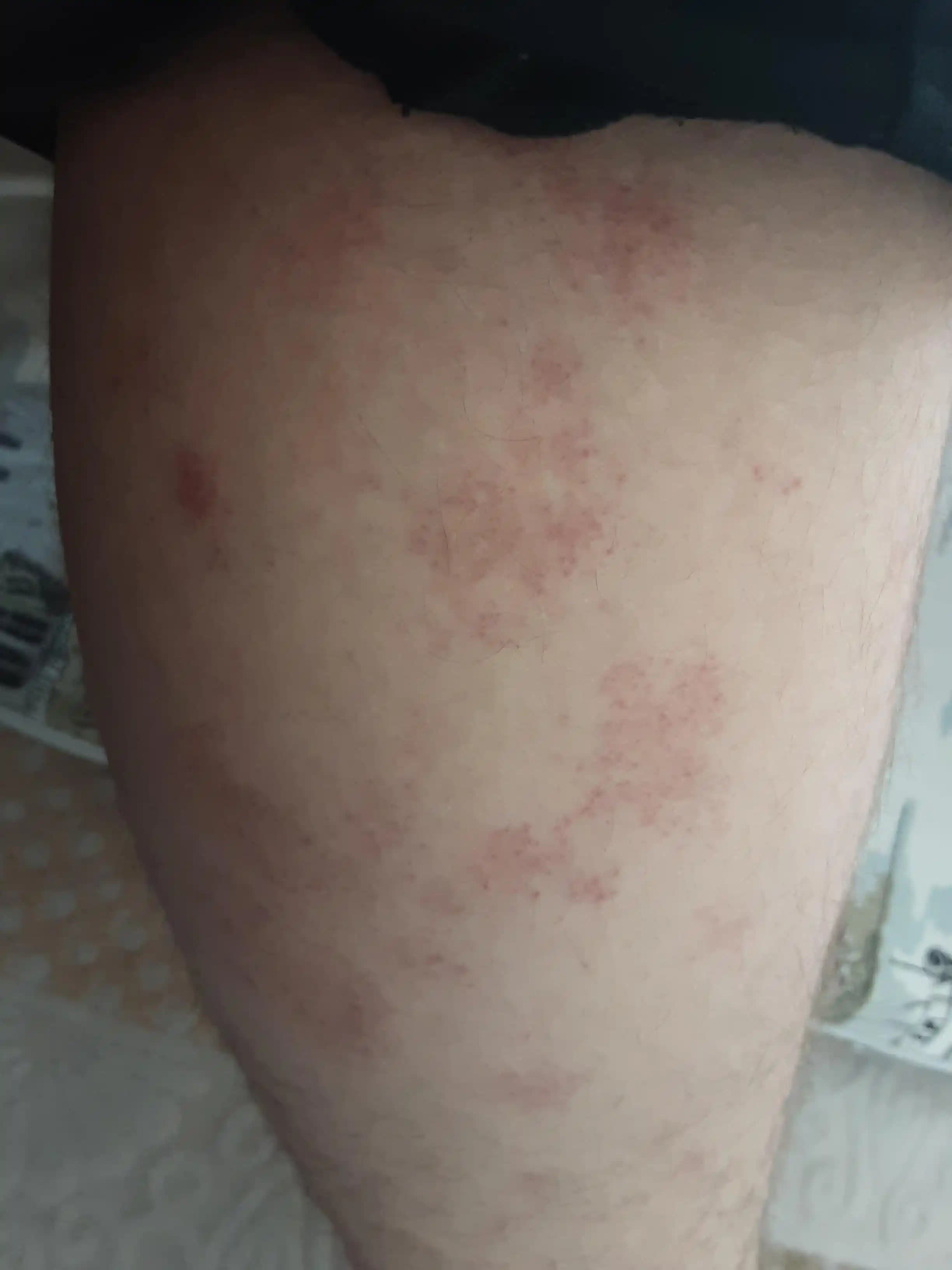 Vücutta Sonradan Çıkan Lekelerin Nedenleri ve Güzellik İçin Çözüm Yolları