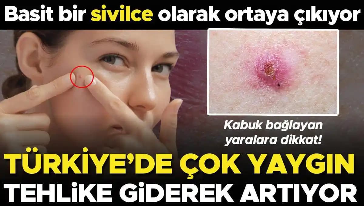 Vücutta Tüm Yerde Sivilce Sorunu: Nedenleri, Çözüm Yolları ve Bakım İpuçları