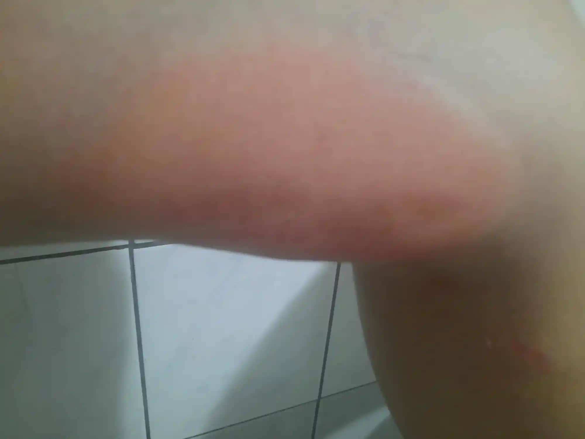 Vücutta Yaraların Çıkmasının Nedenleri ve Cilt Sağlığını Koruma Yöntemleri