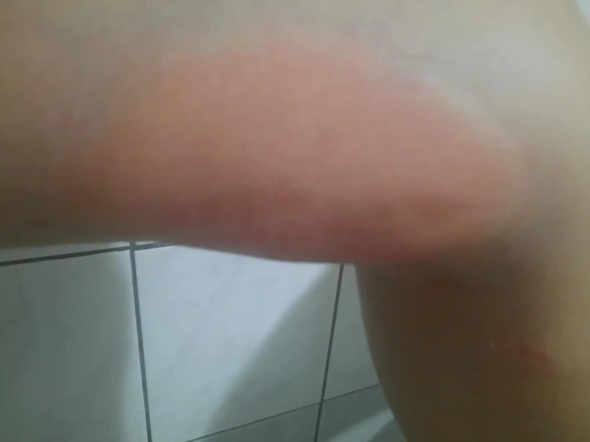 Vücutta Yaraların Çıkmasının Nedenleri ve Cilt Sağlığını Koruma Yöntemleri