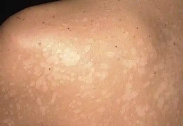 Vücutta Yeşil Lekeler: Nedenleri, Çözümleri ve Güncel Tedavi Yöntemleri