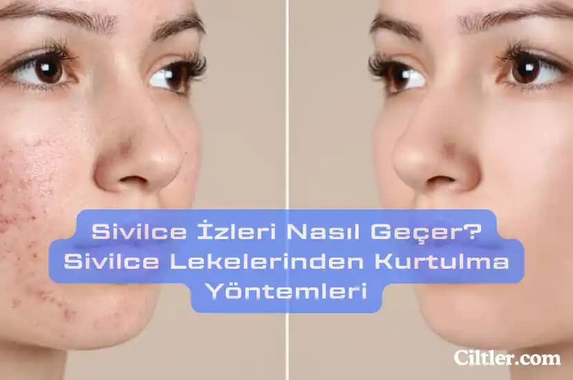 Yağlı Ciltlerde Sivilce İzlerini Hafifletmenin Etkili Yolları ve Uzman Tavsiyeleri