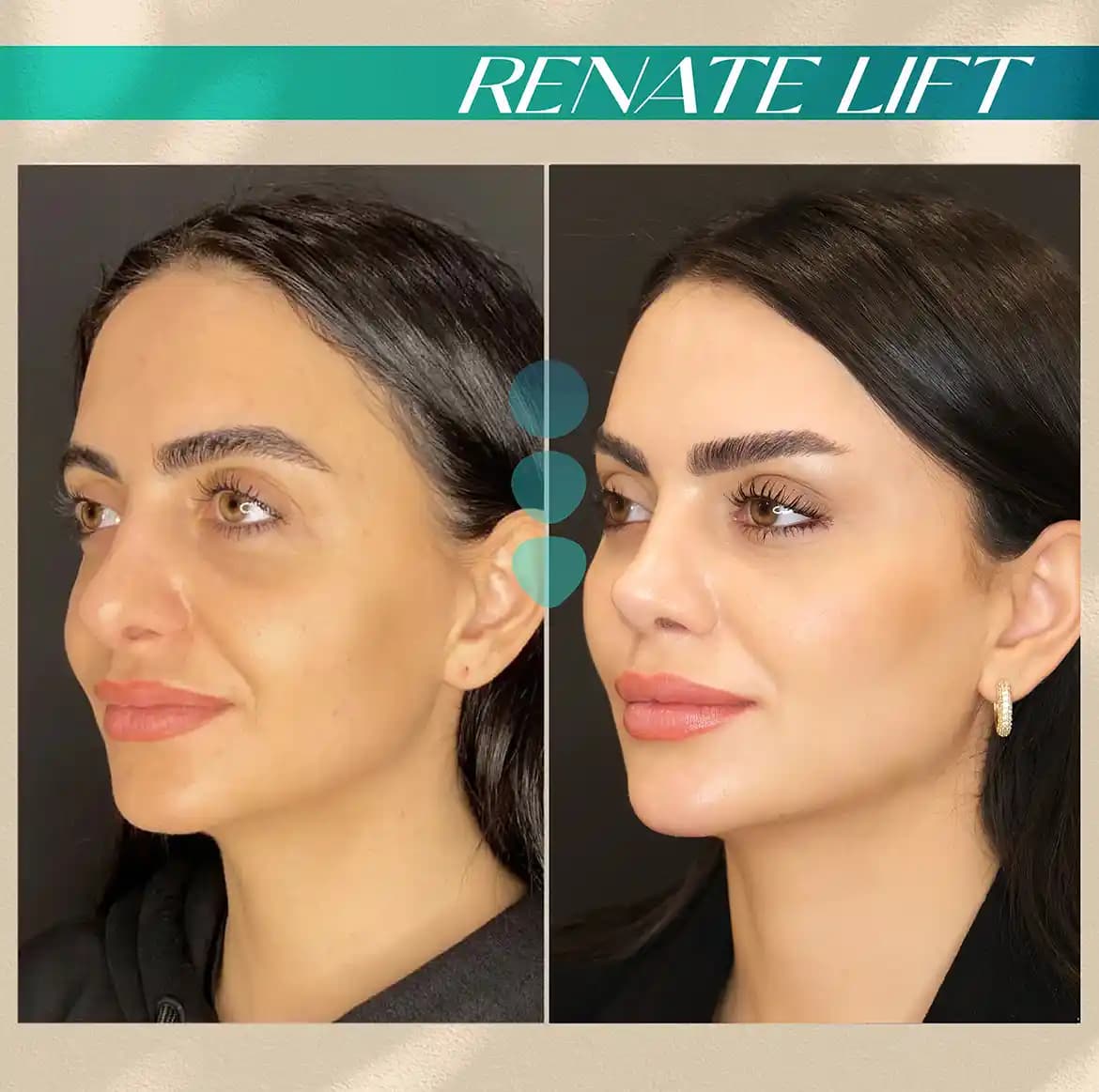 Yanak Dolgunlaştırma Yöntemleri ve Estetik Uygulamalar Hakkında Detaylı Bilgi