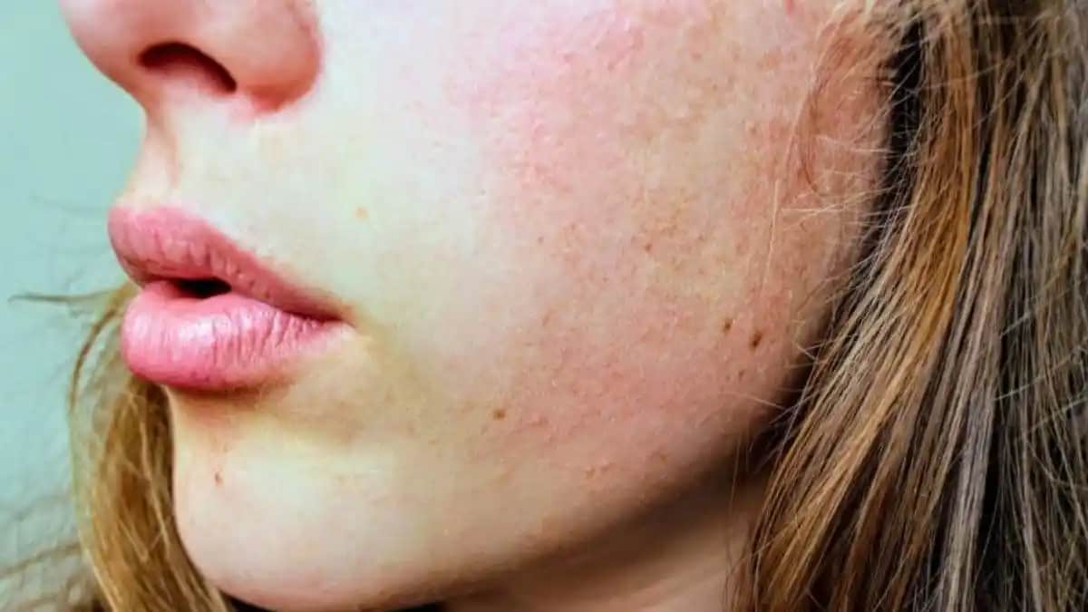 Yanaklarda Egzama Nedenleri, Belirtileri ve Etkili Tedavi Yöntemleri