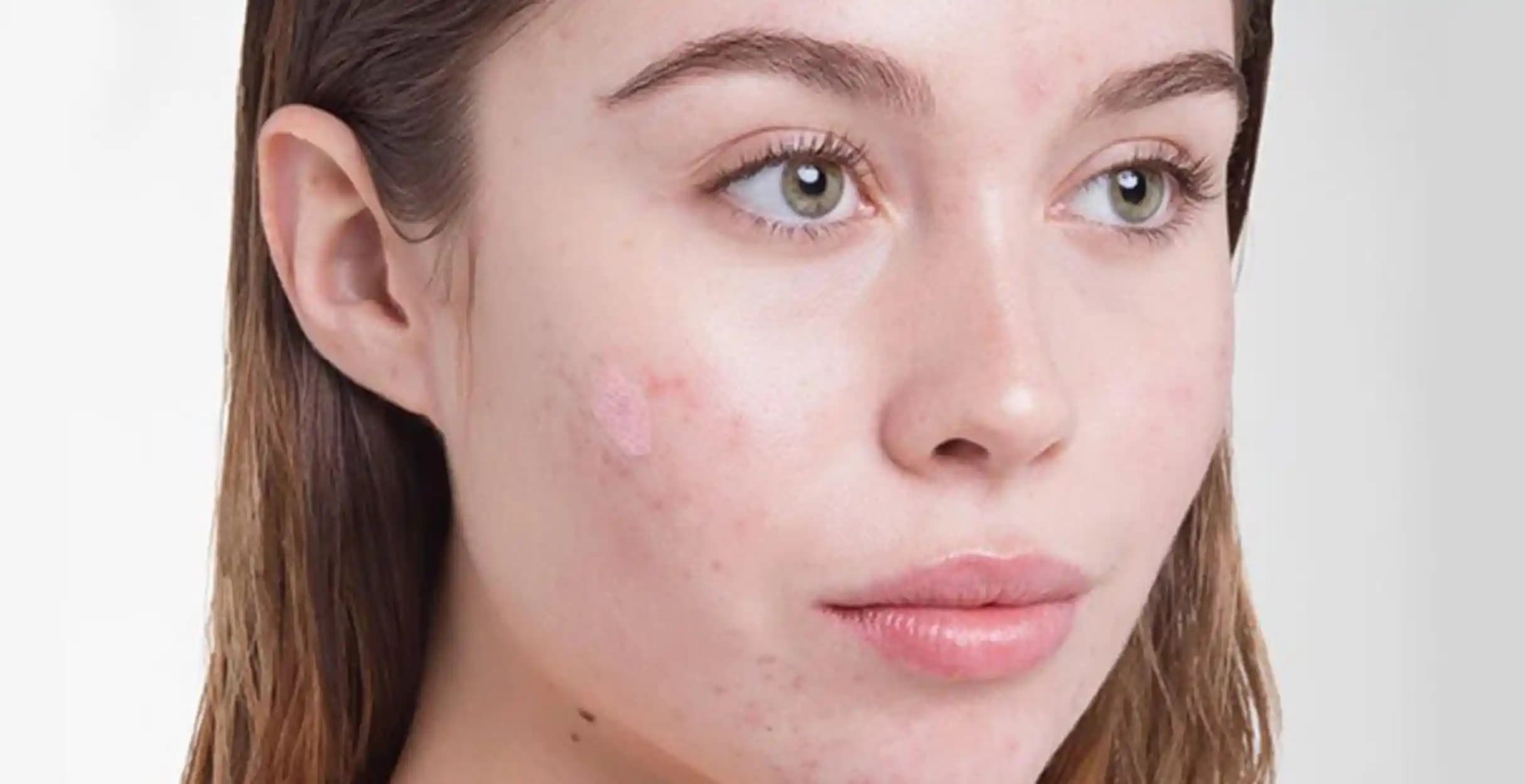 Yanakta Sivilce Nedenleri ve Etkili Önlemler Hakkında Bilmeniz Gerekenler