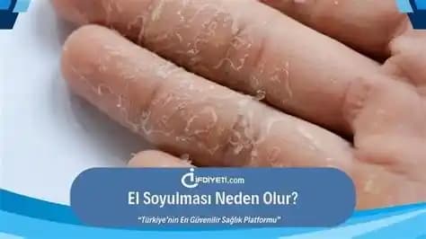 Yanık Derisinin Soyulması: Nedenleri, Belirtileri ve Etkili Bakım Yöntemleri