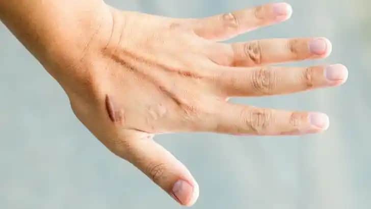 Yara İzleri Nasıl Geçer En Etkili Yöntemler ve Cilt Bakım İpuçları